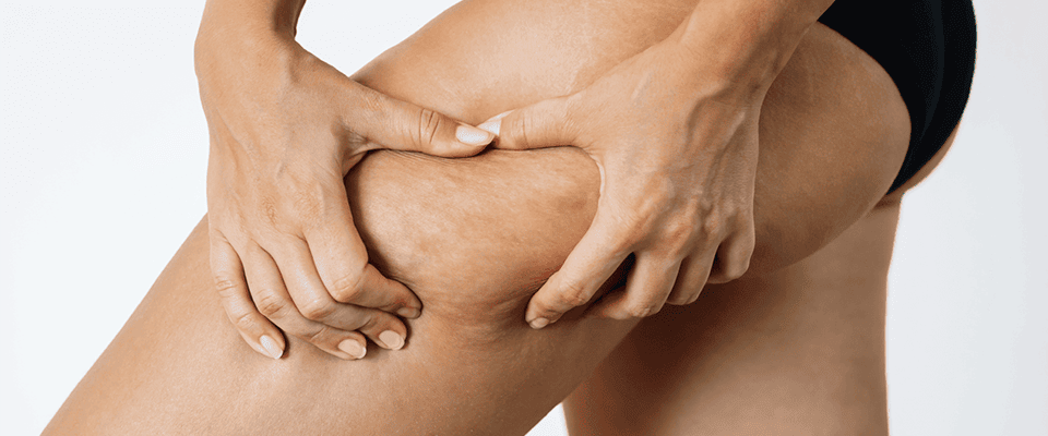 Comprendre la cellulite : types, causes et solutions esthétiques efficaces