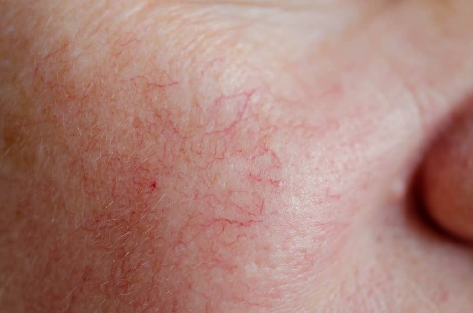 La couperose & la rosacée : soins traitants esthétiques des peaux à tendance couperosique