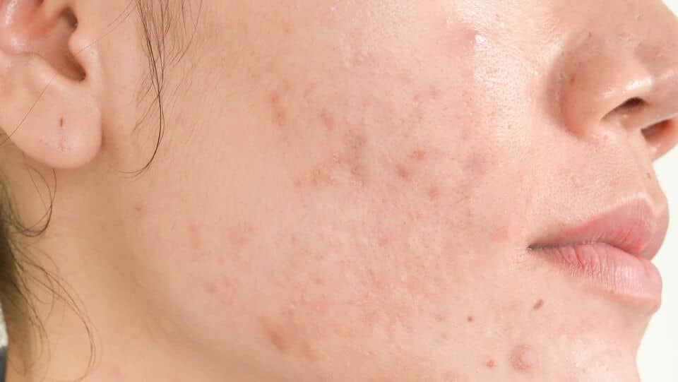 L'acné : soins traitants esthétiques des peaux à tendance acnéique