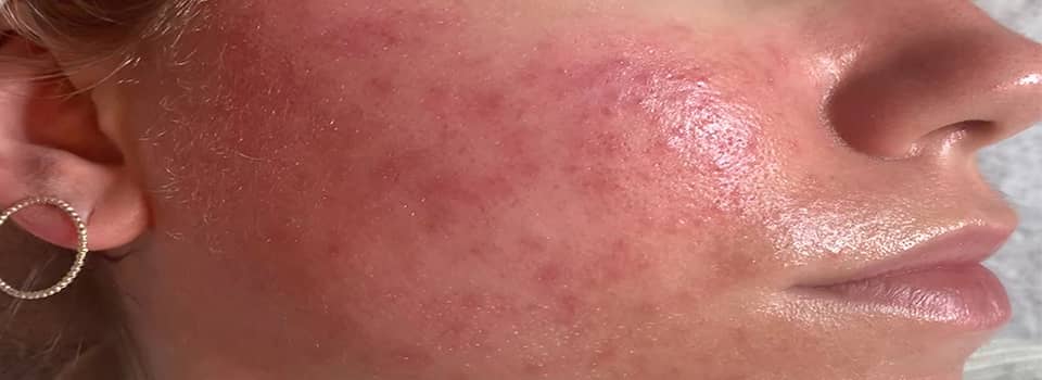 Effraction cutanée : des pratiques mettent en danger la santé des clients
